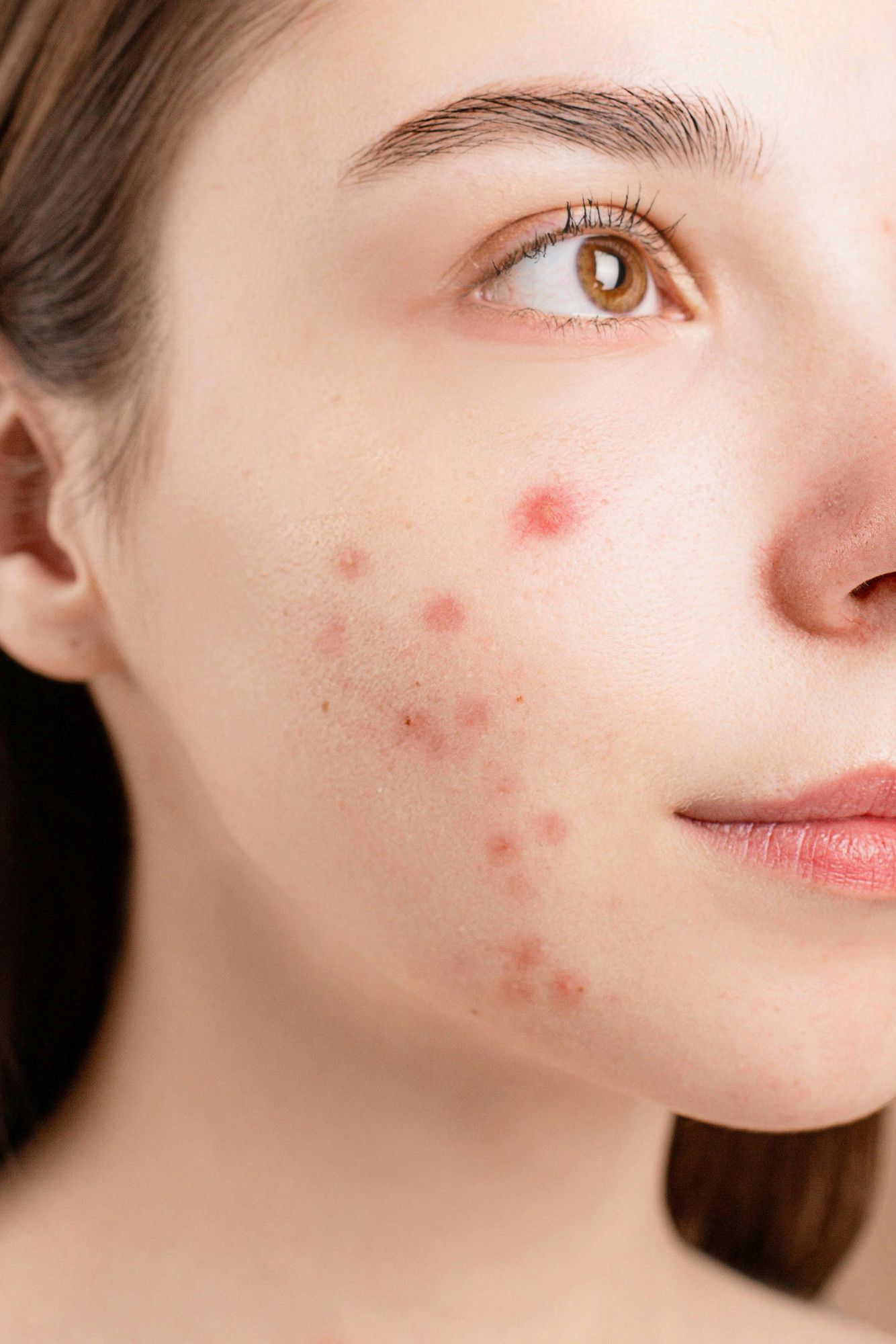 acne-2.jpg