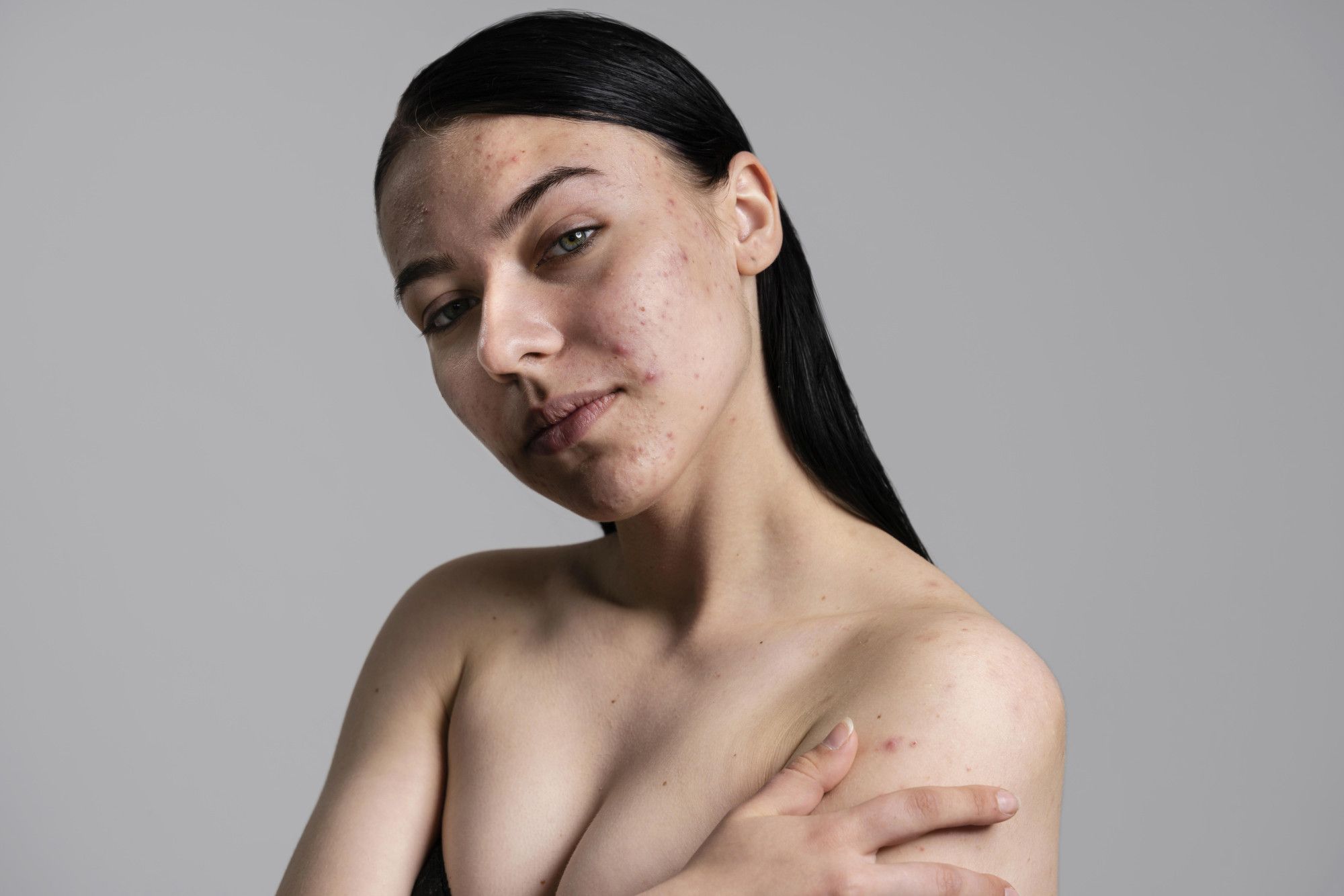 acne.jpg