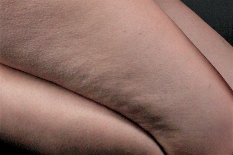 cellulite-768x512.jpg