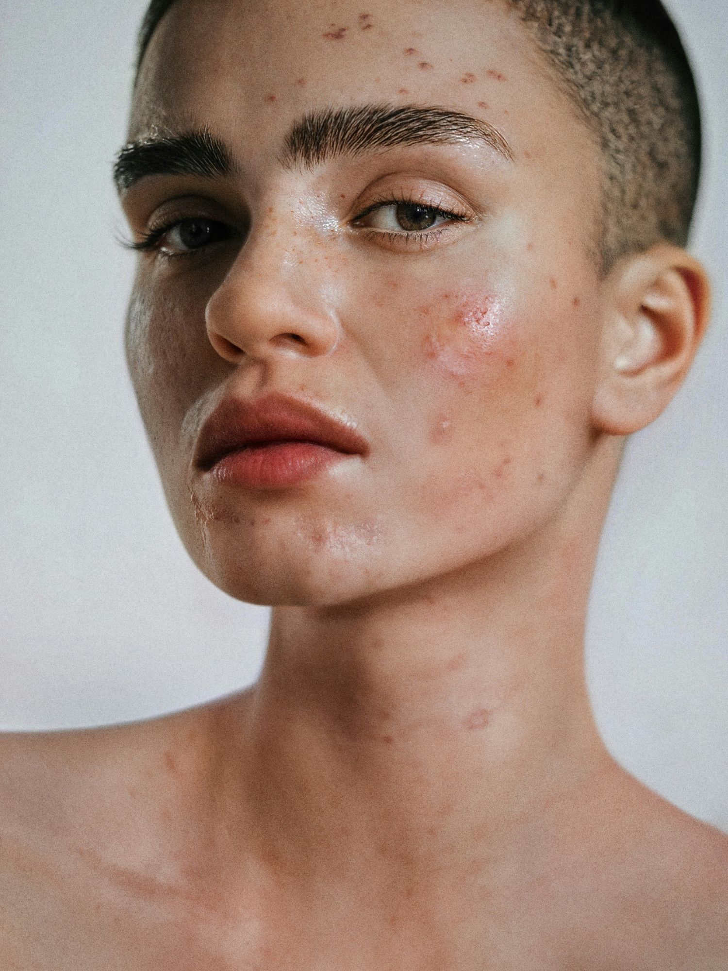 eczeem-1.jpg