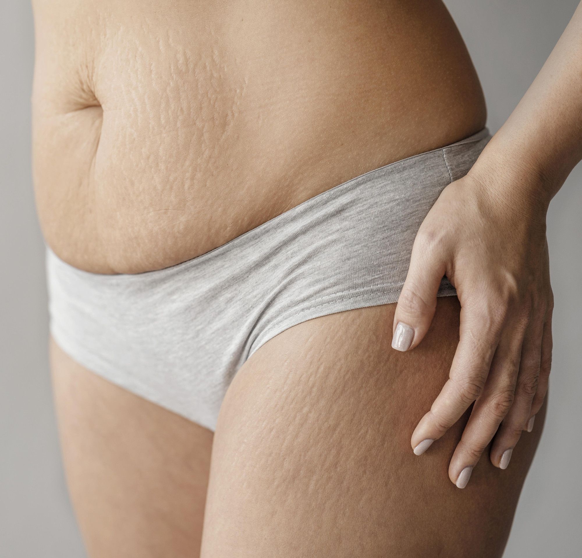 close-up-woman-body-with-stretch-marks.jpg