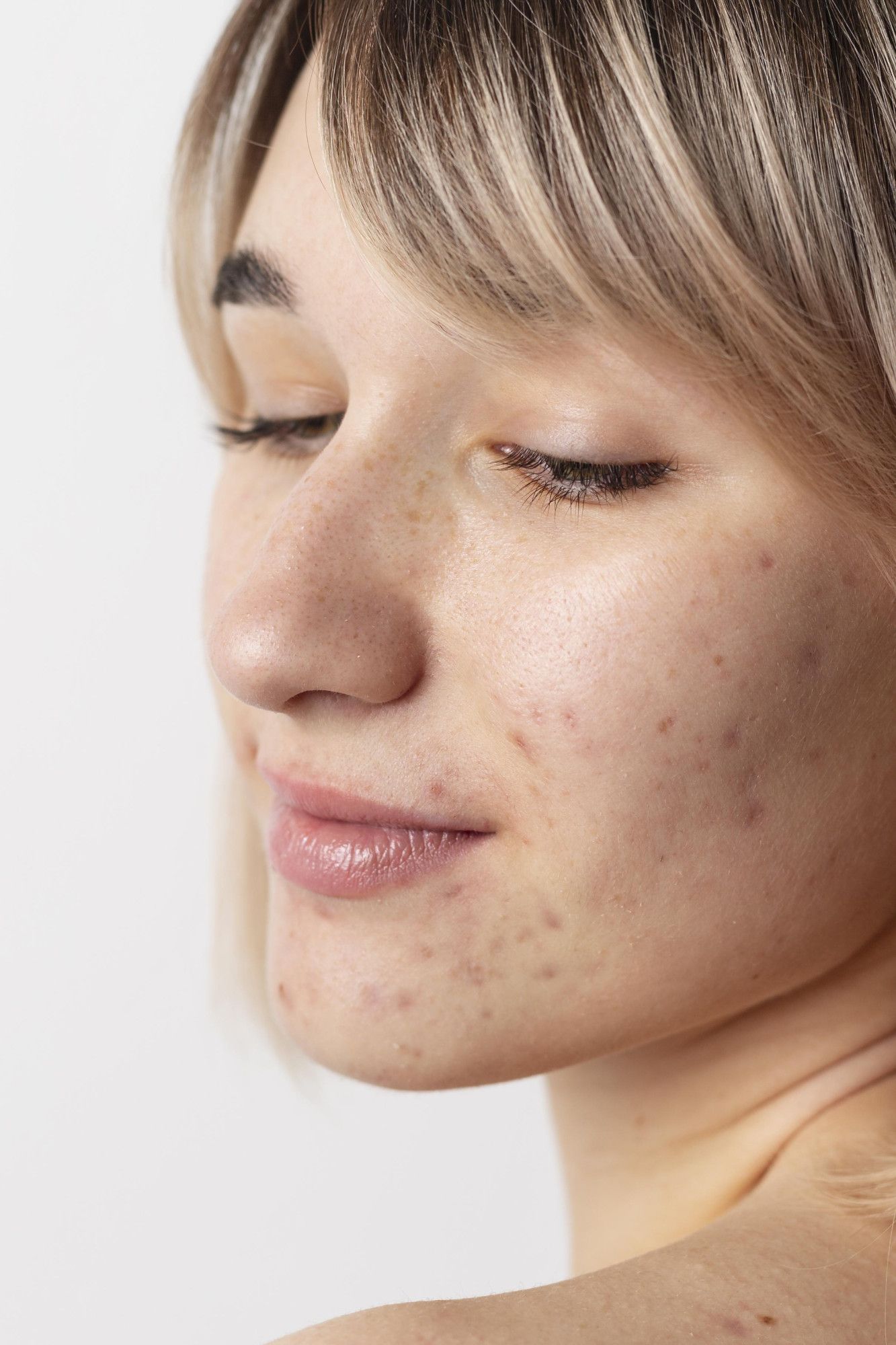 close-up-woman-with-acne-posing.jpg