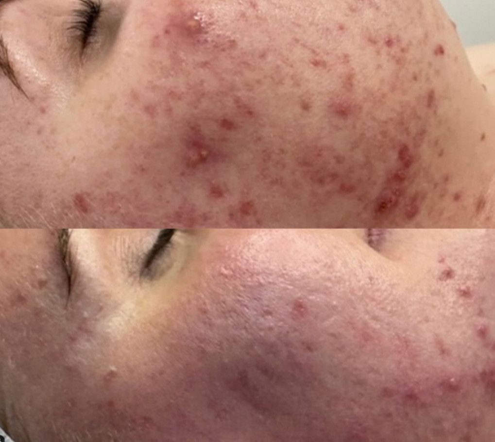 acne-littekens.jpg
